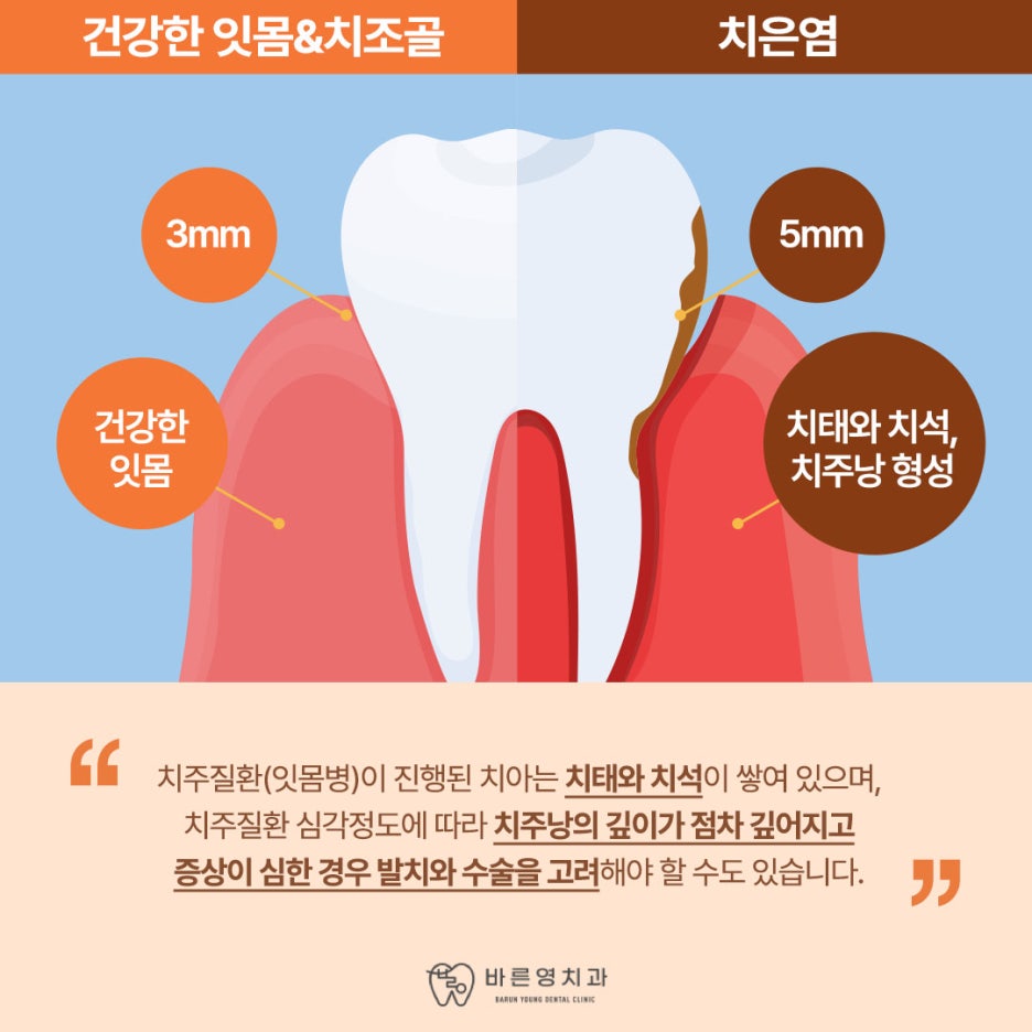 금호동치과, 자연치아 오래 사용하고 싶다면 잇몸병 방치하지 말아야 사진 5