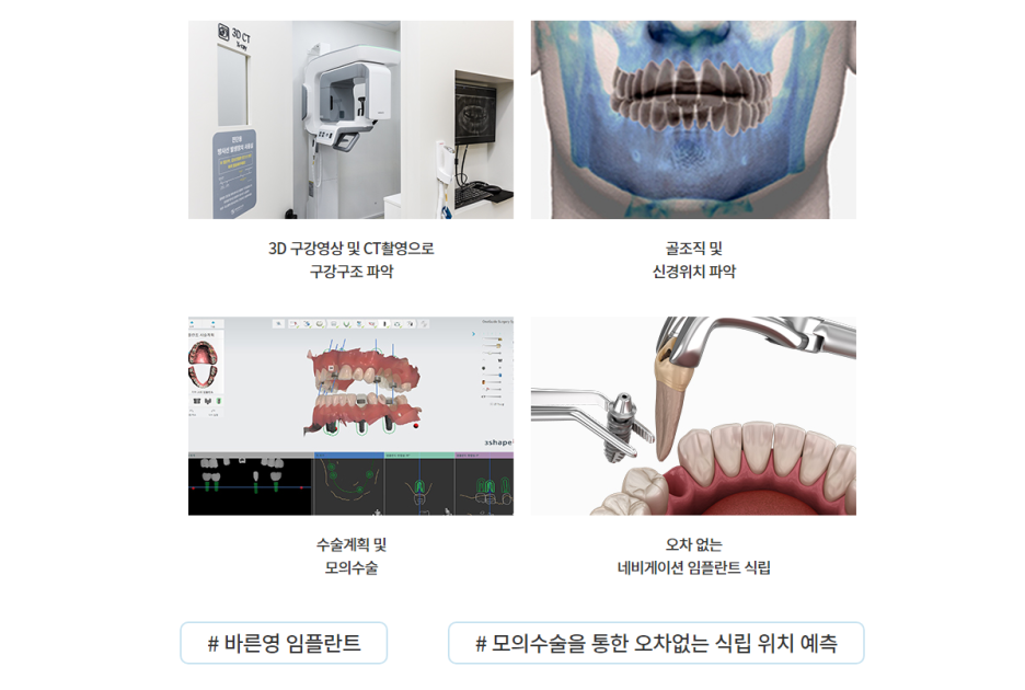 약수역치과, 빠진 치아 그냥 두지 말고 임플란트로 새롭게 사진 11