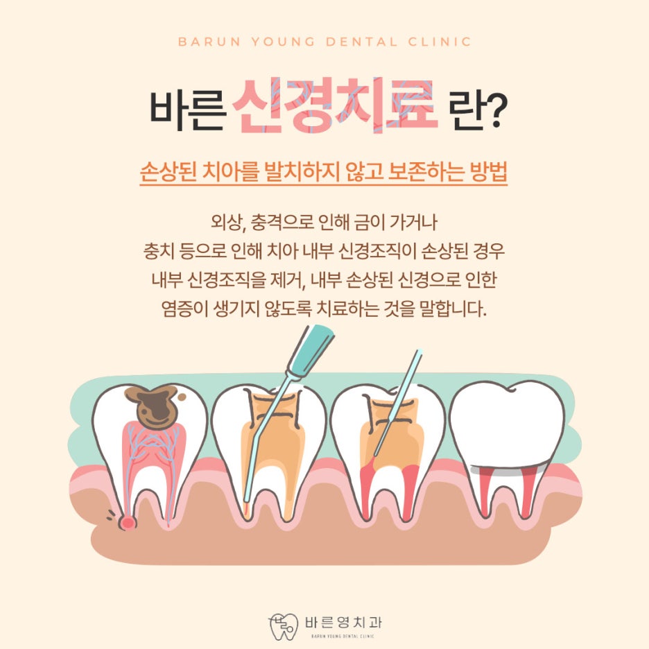장충동치과, 충치치료와 신경치료 미루지 말고 적기에! 사진 8