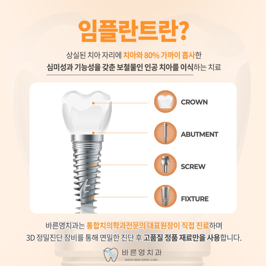 신금호역치과, 안내 따라 진행하여 안정적인 네비게이션임플란트 사진 4