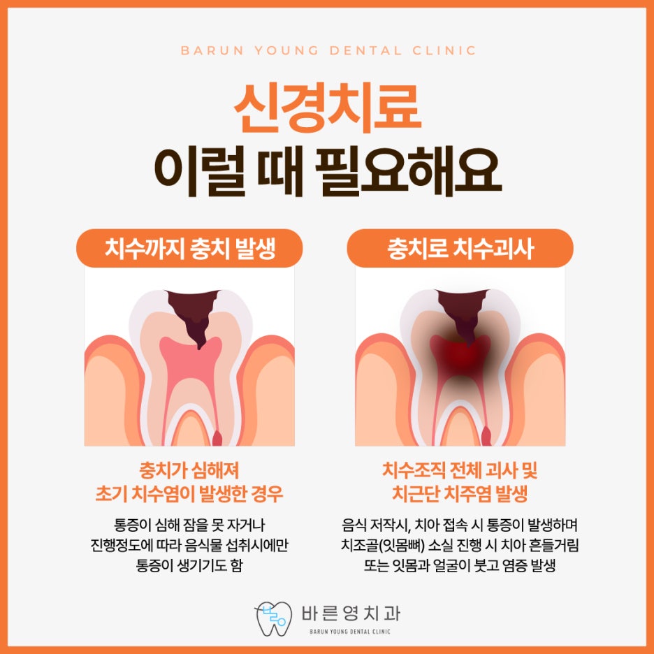 약수역치과, 충치 방치하면 할수록 치료 난이도는 올라갑니다. 사진 7