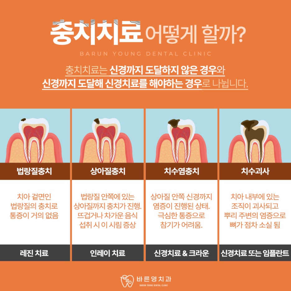 약수역치과, 충치 방치하면 할수록 치료 난이도는 올라갑니다. 사진 6