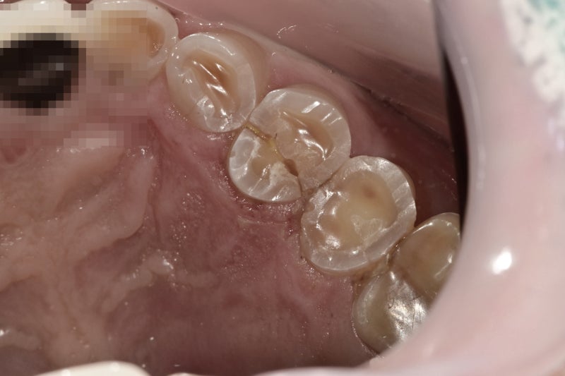 약수역 치과 크랙 치아 (금 간 치아)
