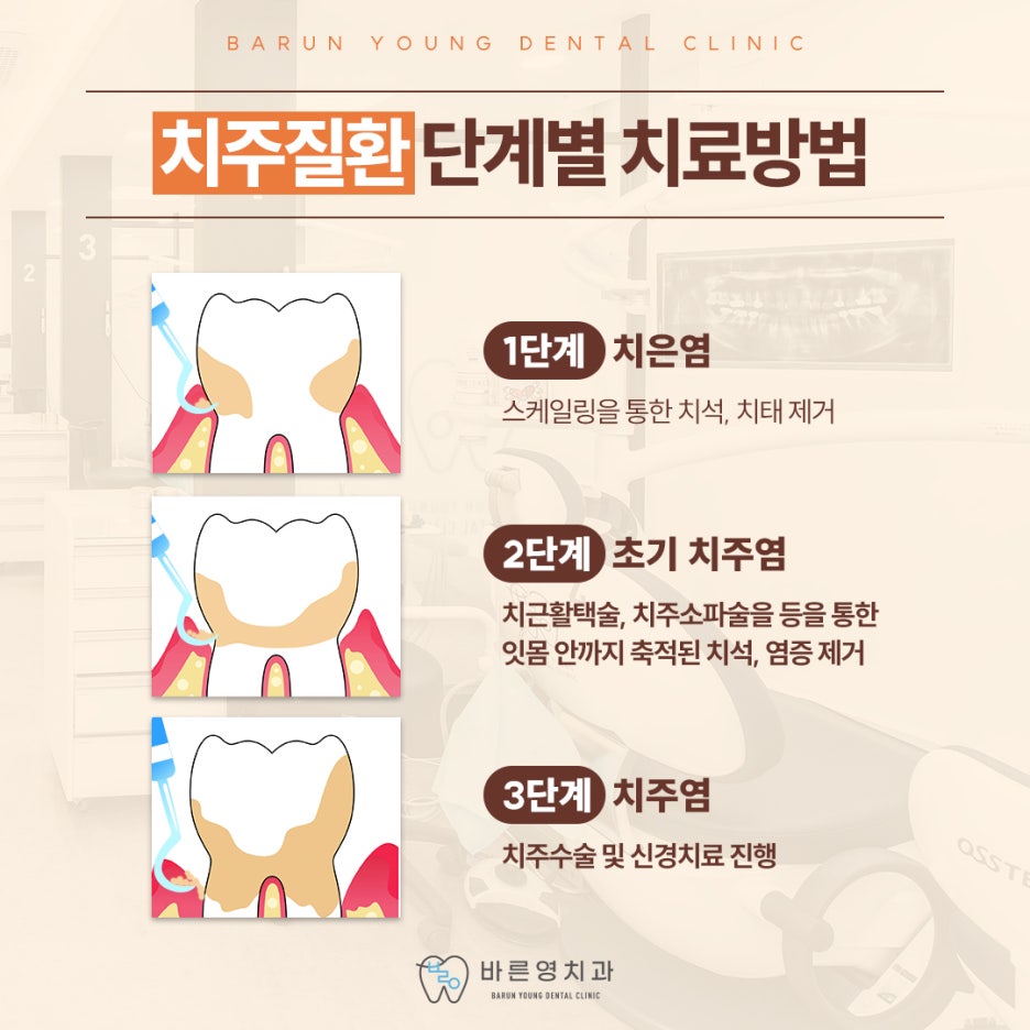 금호동치과, 잇몸 피나고 시린 치주질환 스케일링으로 예방해요 사진 8