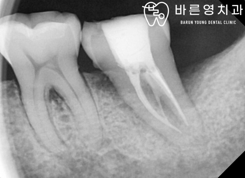옥수역치과, 충치치료 조기에 해야 자연치아 보존률 UP! 사진 12