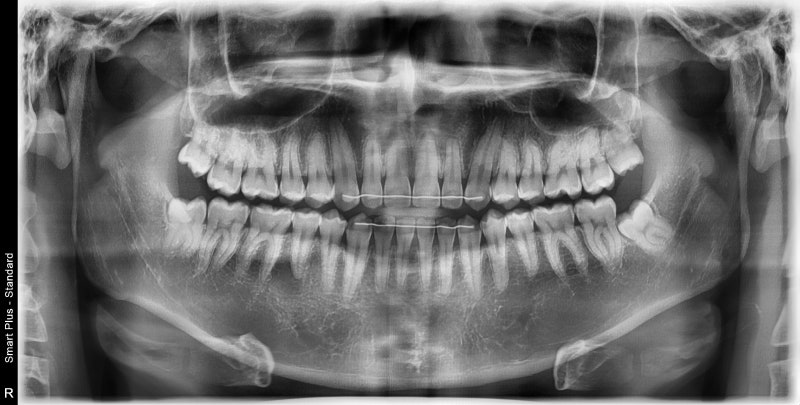Yaksuyeok Dental Clinic, Temporomandibular Joint Disorders (Botox Treatment)