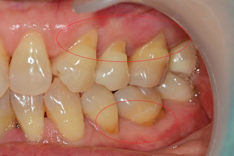 Yaksuyeok Dental Clinic, Temporomandibular Joint Disorders (Botox Treatment) 사진 6