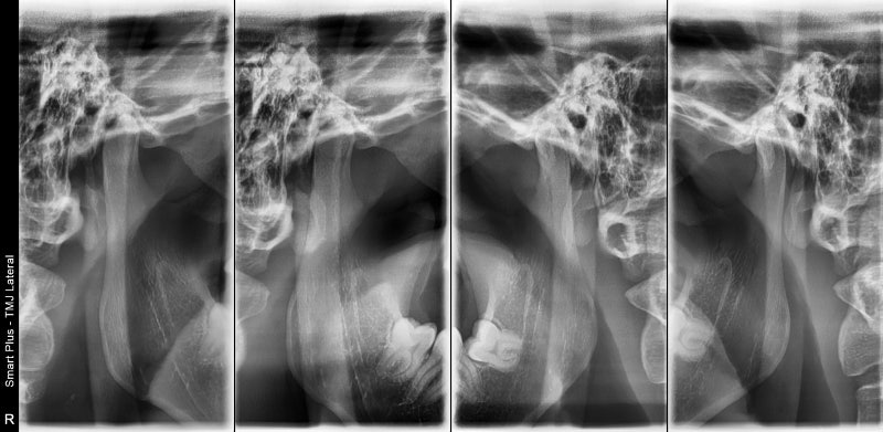 Yaksuyeok Dental Clinic, Temporomandibular Joint Disorders (Botox Treatment) 사진 3