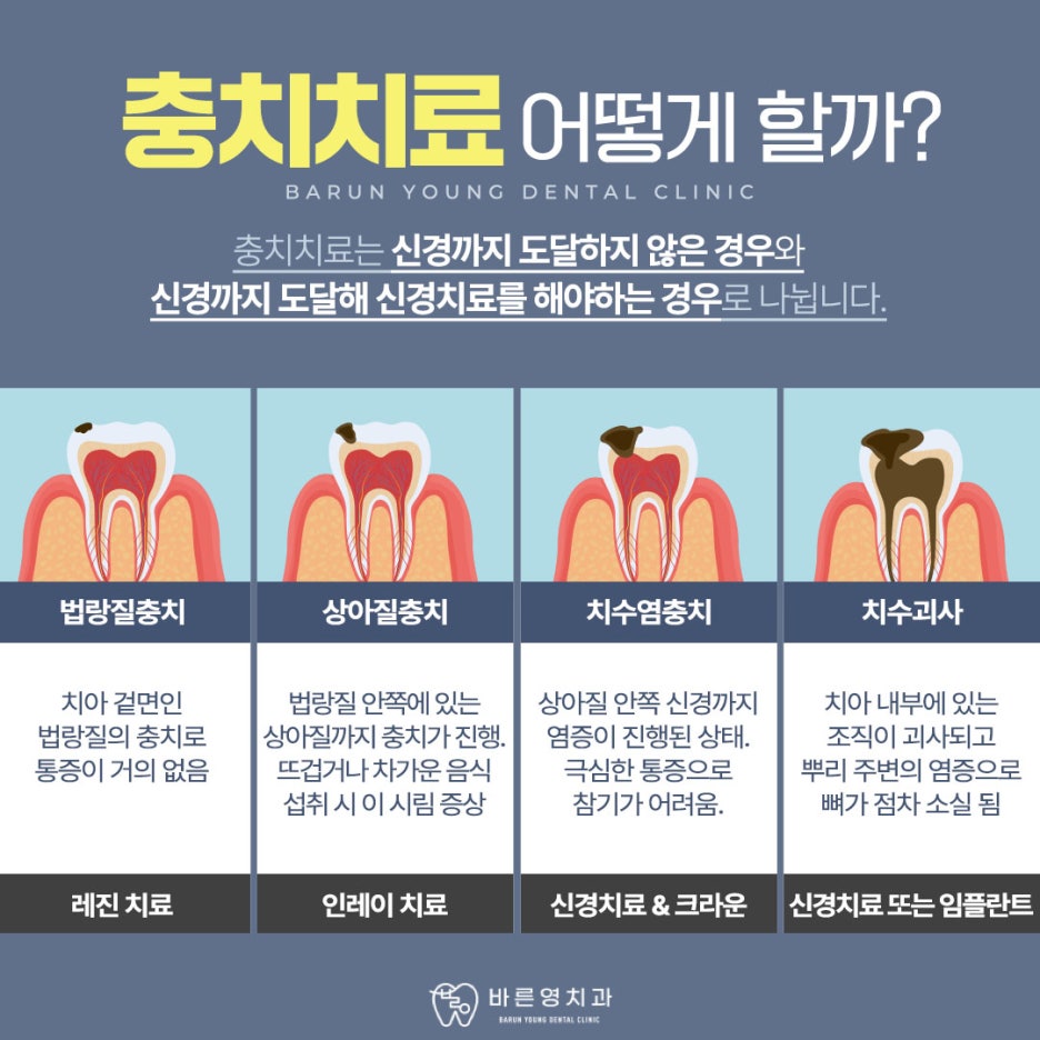 Cheonggudong Dental Clinic: Don't Miss the Timing for Cavity and Root Canal Treatment 사진 7