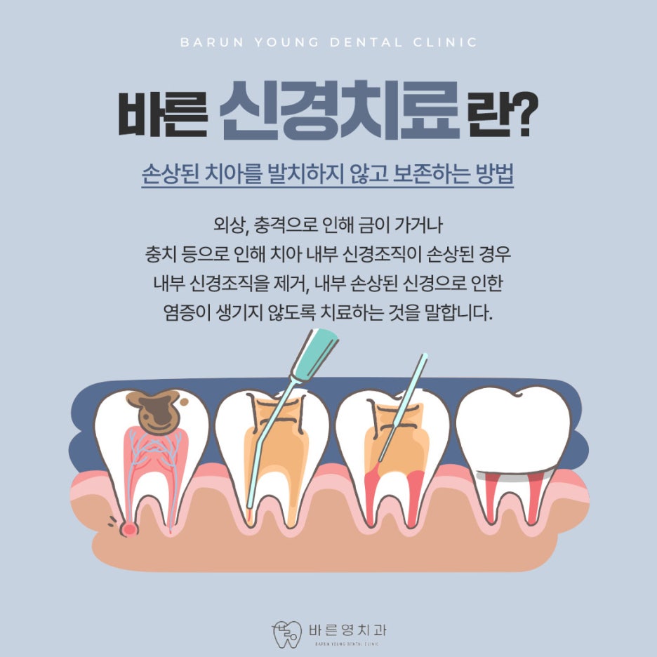 Cheonggudong Dental Clinic: Don't Miss the Timing for Cavity and Root Canal Treatment 사진 8