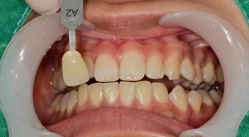 Yaksu Station Dental Clinic: Can a single visit for teeth whitening be effective? (feat. One-Day Whitening) 사진 5