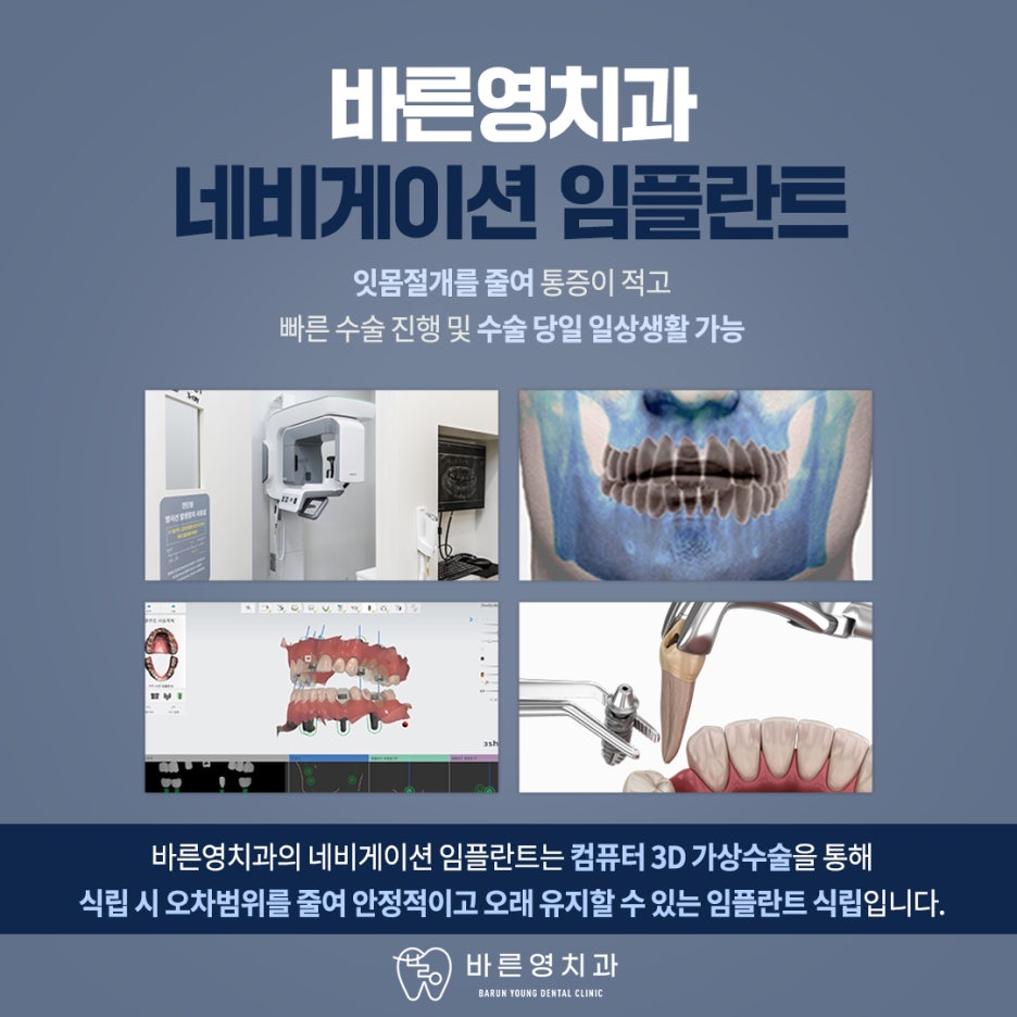 다산동치과, 안정적인 임플란트 치료 원한다면 네비게이션 임플란트로 사진 6
