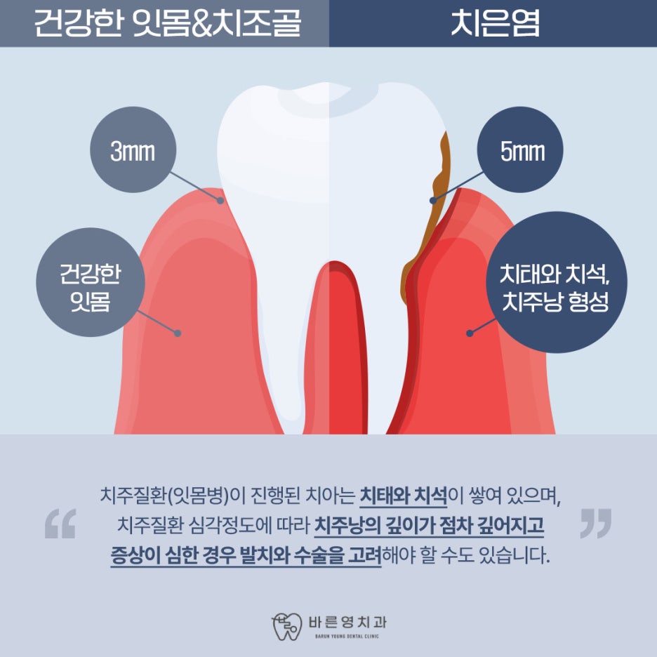 玉水站牙科:牙龈肿痛出血,切勿错过治疗时机 사진 5