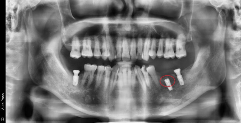 Yaksu Station Dental Clinic: Getting Delayed Implant Treatment (I'm Scared of the Dentist)
