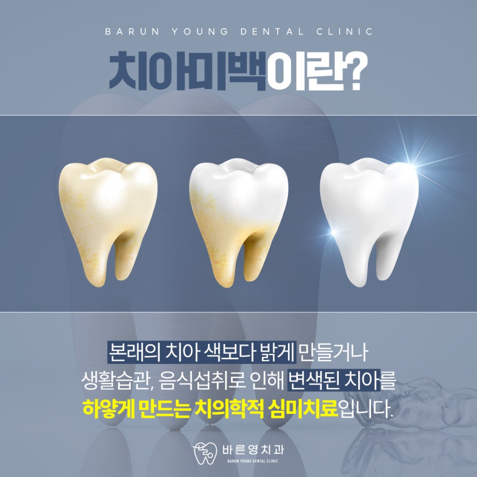 Cheonggu-dong Dental Clinic: When One-Day Teeth Whitening is Needed