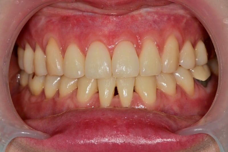 Yaksu Station Dental Clinic: The Effects and Frequency of Teeth Whitening