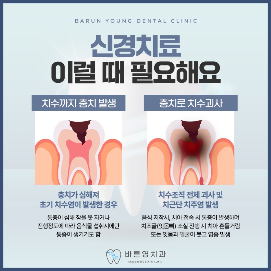 약수역근처치과 자연치아 살리는 충치치료와 신경치료 늦지않아야 사진 7