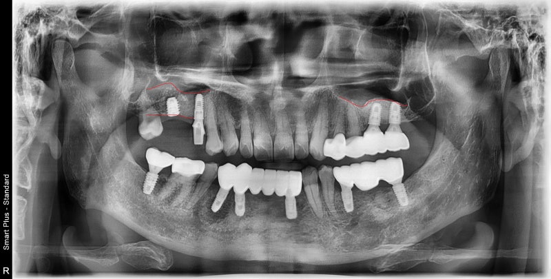 Yaksu Station Dental Clinic: Implant Procedures with Alveolar Bone Grafting and Pain Management (Sinus Lift) 사진 10