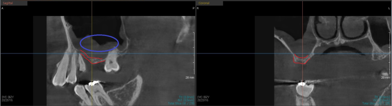 Yaksu Station Dental Clinic: Implant Procedures with Alveolar Bone Grafting and Pain Management (Sinus Lift) 사진 6