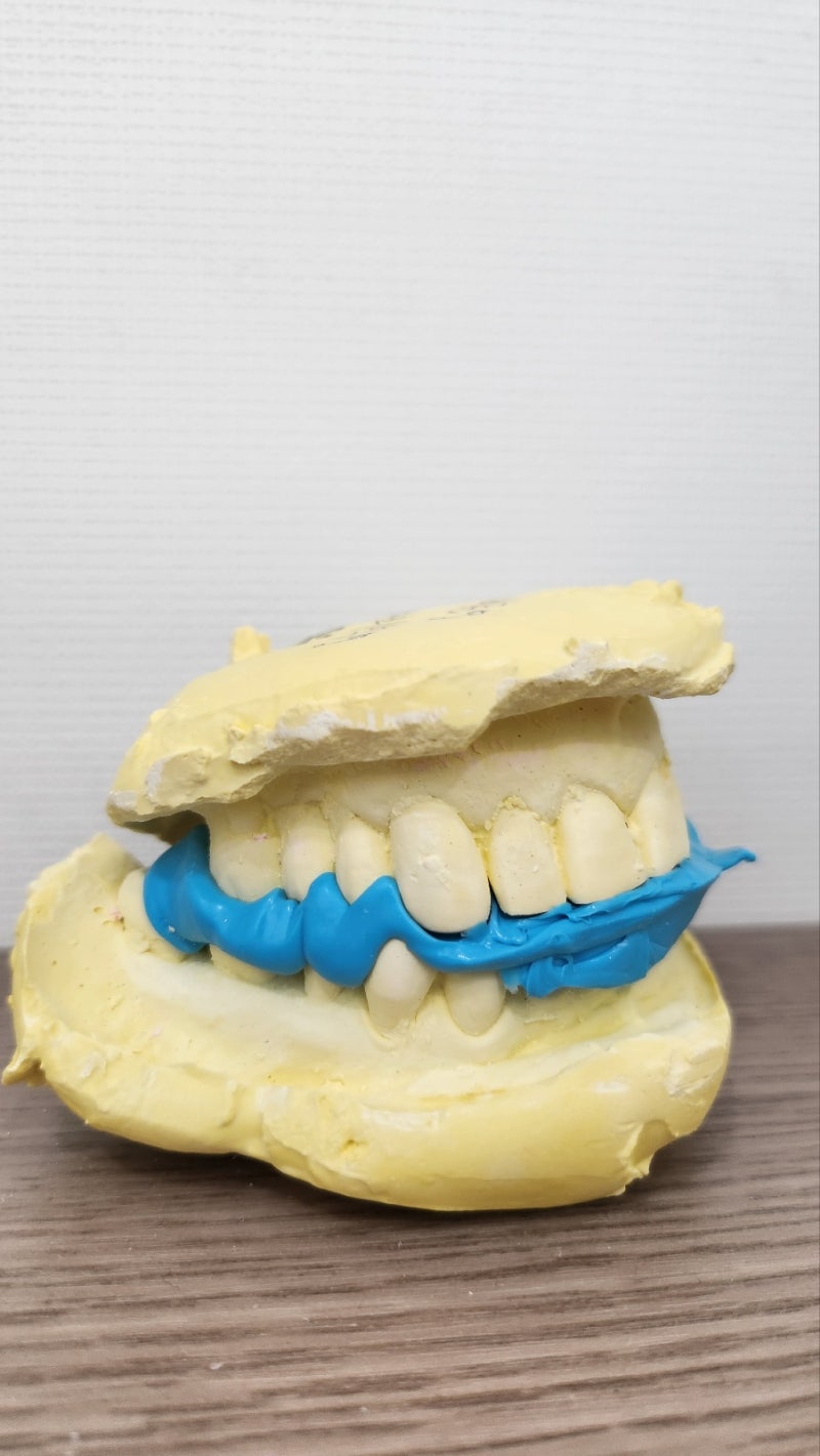 Yaksu Station Dental Clinic: Implant Surgery with Navigation (Guided Implants) 사진 2