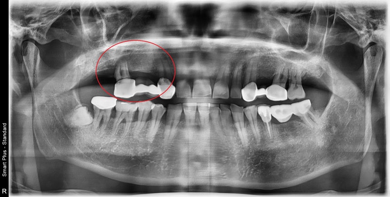 Yaksu Station Dental Clinic: Implant Surgery with Navigation (Guided Implants)