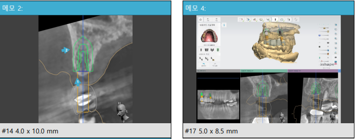 Yaksu Station Dental Clinic: Implant Surgery with Navigation (Guided Implants) 사진 3