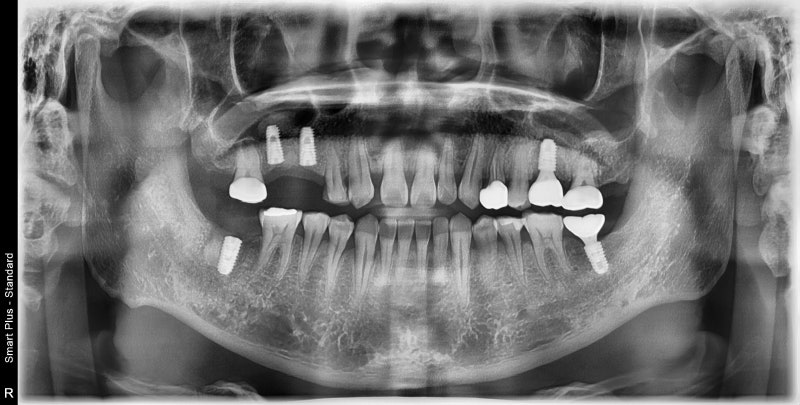 عيادة ياكسو ستيشن لطب الأسنان: ما هو الوقت المناسب لزراعة الأسنان بعد الخلع؟ 사진 6