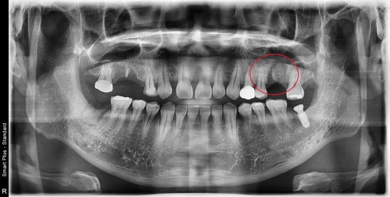 عيادة ياكسو ستيشن لطب الأسنان: ما هو الوقت المناسب لزراعة الأسنان بعد الخلع؟ 사진 4