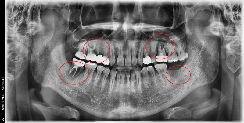 عيادة ياكسو ستيشن لطب الأسنان: ما هو الوقت المناسب لزراعة الأسنان بعد الخلع؟