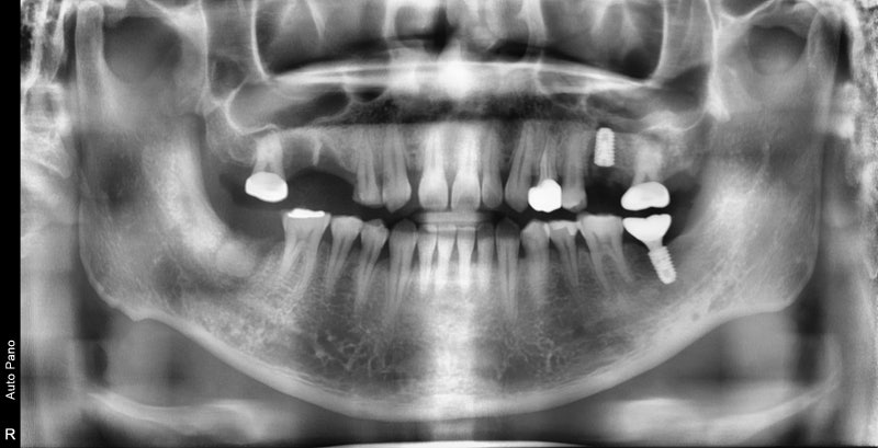 عيادة ياكسو ستيشن لطب الأسنان: ما هو الوقت المناسب لزراعة الأسنان بعد الخلع؟ 사진 5