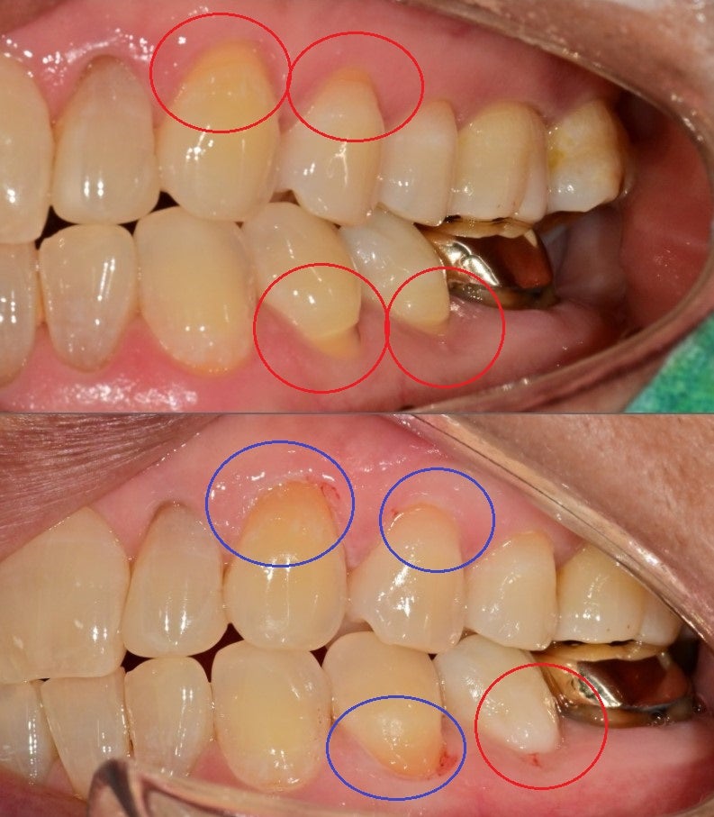 عيادة أسنان محطة ياكسو، ما هو العلاج الذي يجب أن يتم لتآكل عنق السن؟ (أسباب وطرق حل حساسية الأسنان) 사진 8