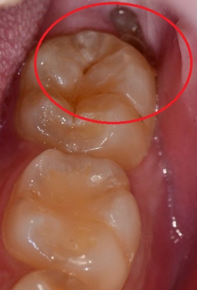 عيادة كومهو لطب الأسنان، لماذا تتورم اللثة المحيطة بضرس العقل؟ (التهاب اللثة حول ضرس العقل المطمور) 사진 2