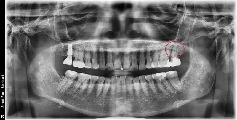 Klinik Gigi Yaksuyeok, Perawatan Socket Preservation Setelah Pencabutan Gigi dengan Peradangan di Sekitar Akar Gigi yang