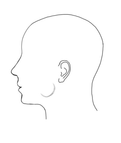 Klinik Gigi Sindang-dong, Gejala yang Dapat Muncul Setelah Suntikan Botox Rahang (Rahang Kotak, Otot Pengunyah, Fenomena