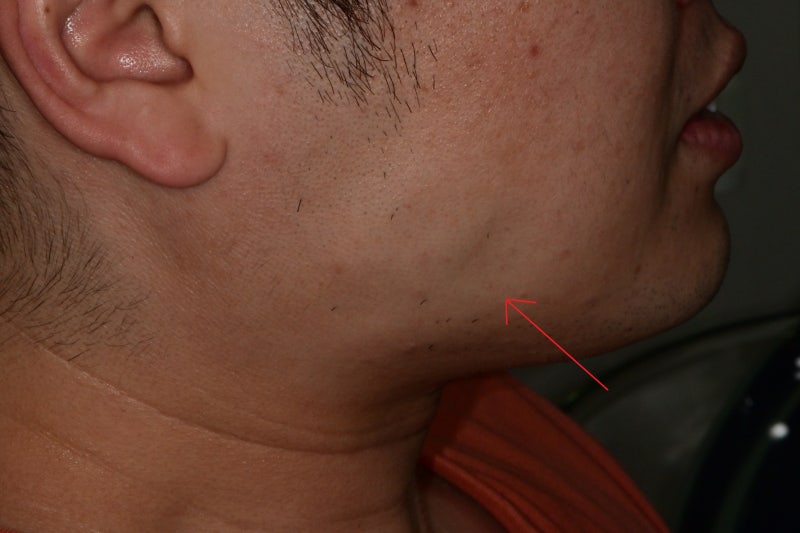 Klinik Gigi Sindang-dong, Gejala yang Dapat Muncul Setelah Suntikan Botox Rahang (Rahang Kotak, Otot Pengunyah, Fenomena