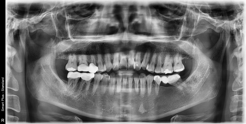 Yaksuyeok Dental Clinic: Is Root Canal Treatment Always Necessary for Cracked Teeth? (Crown Treatment Before Implants, M
