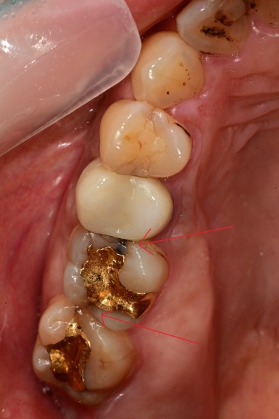 Yaksuyeok Dental Clinic: Is Root Canal Treatment Always Necessary for Cracked Teeth? (Crown Treatment Before Implants, M