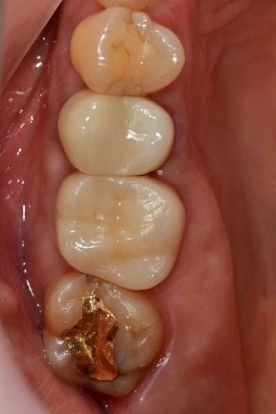 Yaksuyeok Dental Clinic: Is Root Canal Treatment Always Necessary for Cracked Teeth? (Crown Treatment Before Implants, M