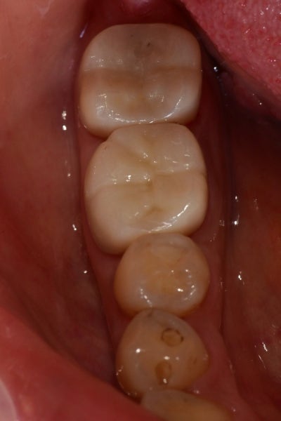 Yaksuyeok Dental Clinic: Is Root Canal Treatment Always Necessary for Cracked Teeth? (Crown Treatment Before Implants, M