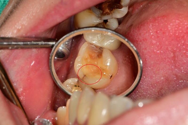 Yaksuyeok Dental Clinic: Is Root Canal Treatment Always Necessary for Cracked Teeth? (Crown Treatment Before Implants, M