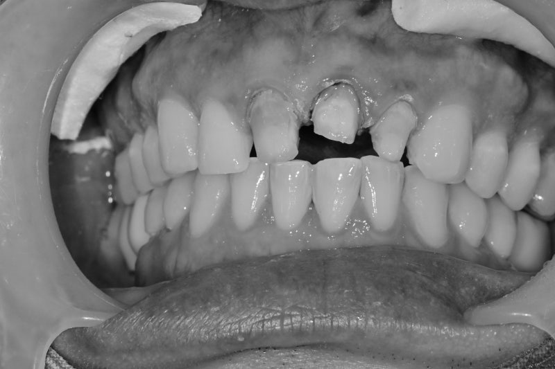 Yaksu Station Dental Clinic, Precautions When Remaking Anterior Esthetic Prosthetics (Is No-Prep Laminate Always Possibl
