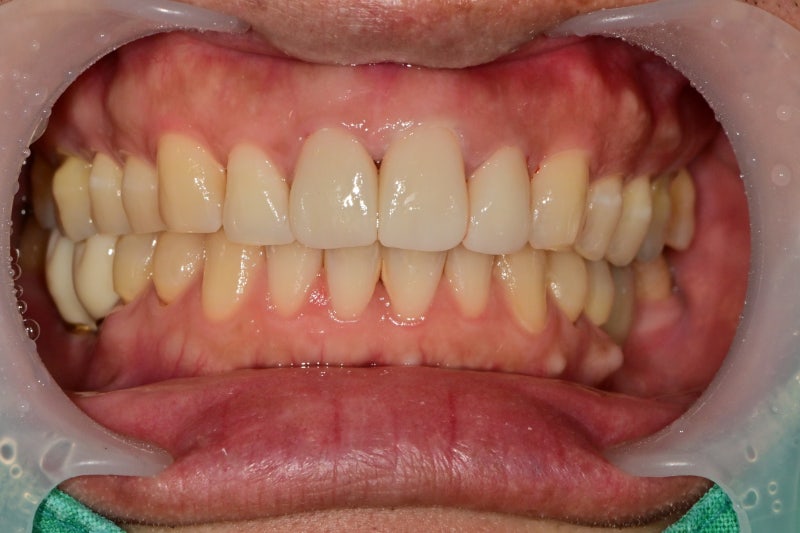 Yaksu Station Dental Clinic, Precautions When Remaking Anterior Esthetic Prosthetics (Is No-Prep Laminate Always Possibl