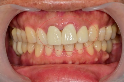 Yaksu Station Dental Clinic, Precautions When Remaking Anterior Esthetic Prosthetics (Is No-Prep Laminate Always Possibl