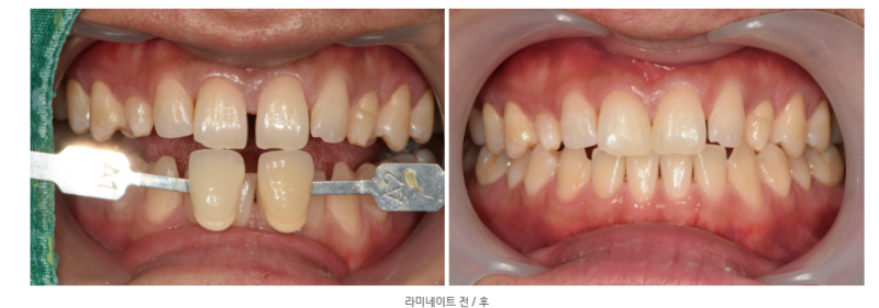 Yaksu Station Dental Clinic, Precautions When Remaking Anterior Esthetic Prosthetics (Is No-Prep Laminate Always Possibl