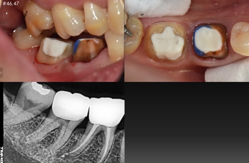 Oksu-dong Dental Clinic: Gum inflammation and pus pockets on a root-canaled tooth won't subside even with medication. (C