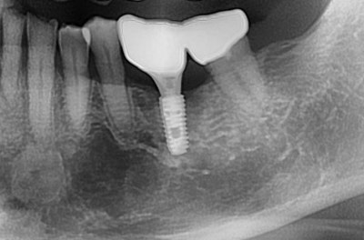 Oksu-dong Dental Clinic: Gum inflammation and pus pockets on a root-canaled tooth won't subside even with medication. (C