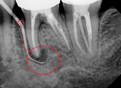 Oksu-dong Dental Clinic: Gum inflammation and pus pockets on a root-canaled tooth won't subside even with medication. (C