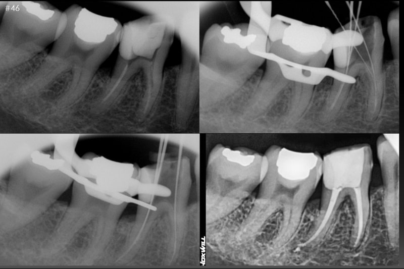Oksu-dong Dental Clinic: Gum inflammation and pus pockets on a root-canaled tooth won't subside even with medication. (C