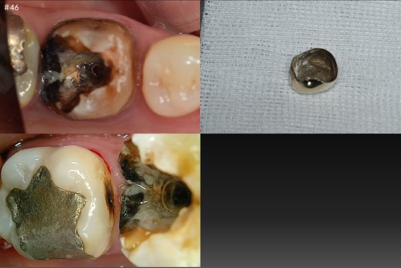 Oksu-dong Dental Clinic: Gum inflammation and pus pockets on a root-canaled tooth won't subside even with medication. (C