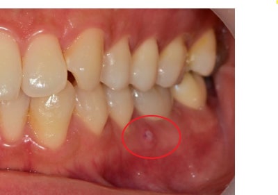 Oksu-dong Dental Clinic: Gum inflammation and pus pockets on a root-canaled tooth won't subside even with medication. (C